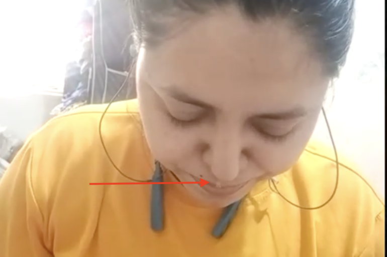 CSF Rhinorrhea Getting cured